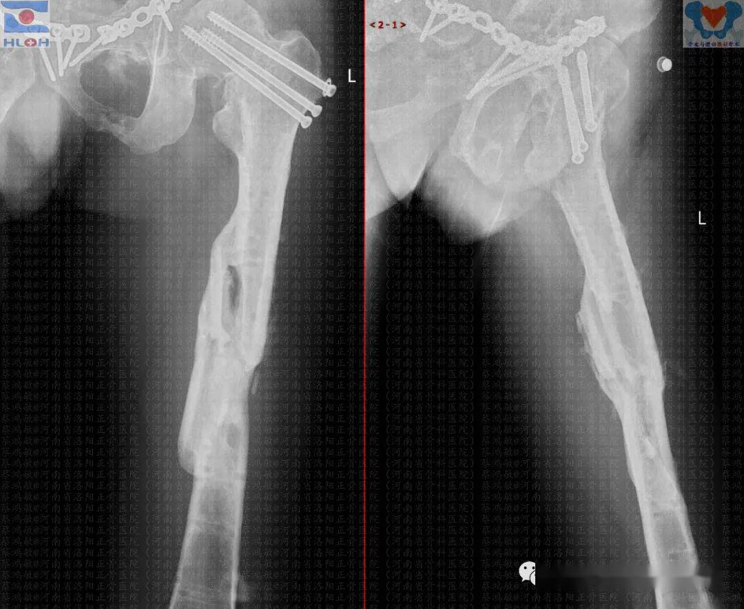 破"颈"重圆:股骨颈骨折术后骨缺损性愈合的治疗