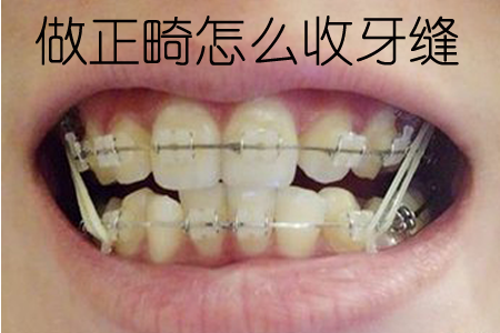 怎么才能让牙齿矫正 827133c5deaa41f5ba61186e5d67521e.png