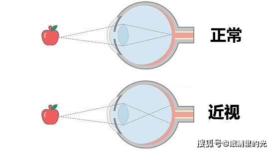 如何让眼睛视力不再增加 891d6c1eac004c18b90772a97e8feb8b.jpeg