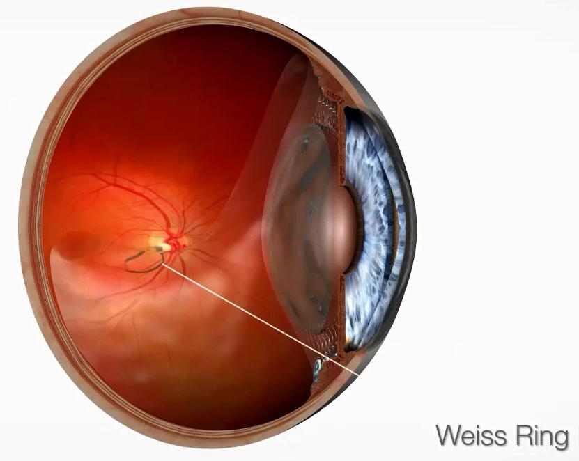 weiss 环▼飞蚊症类型及其治疗方法今天给大家介绍一种常见的影响我们