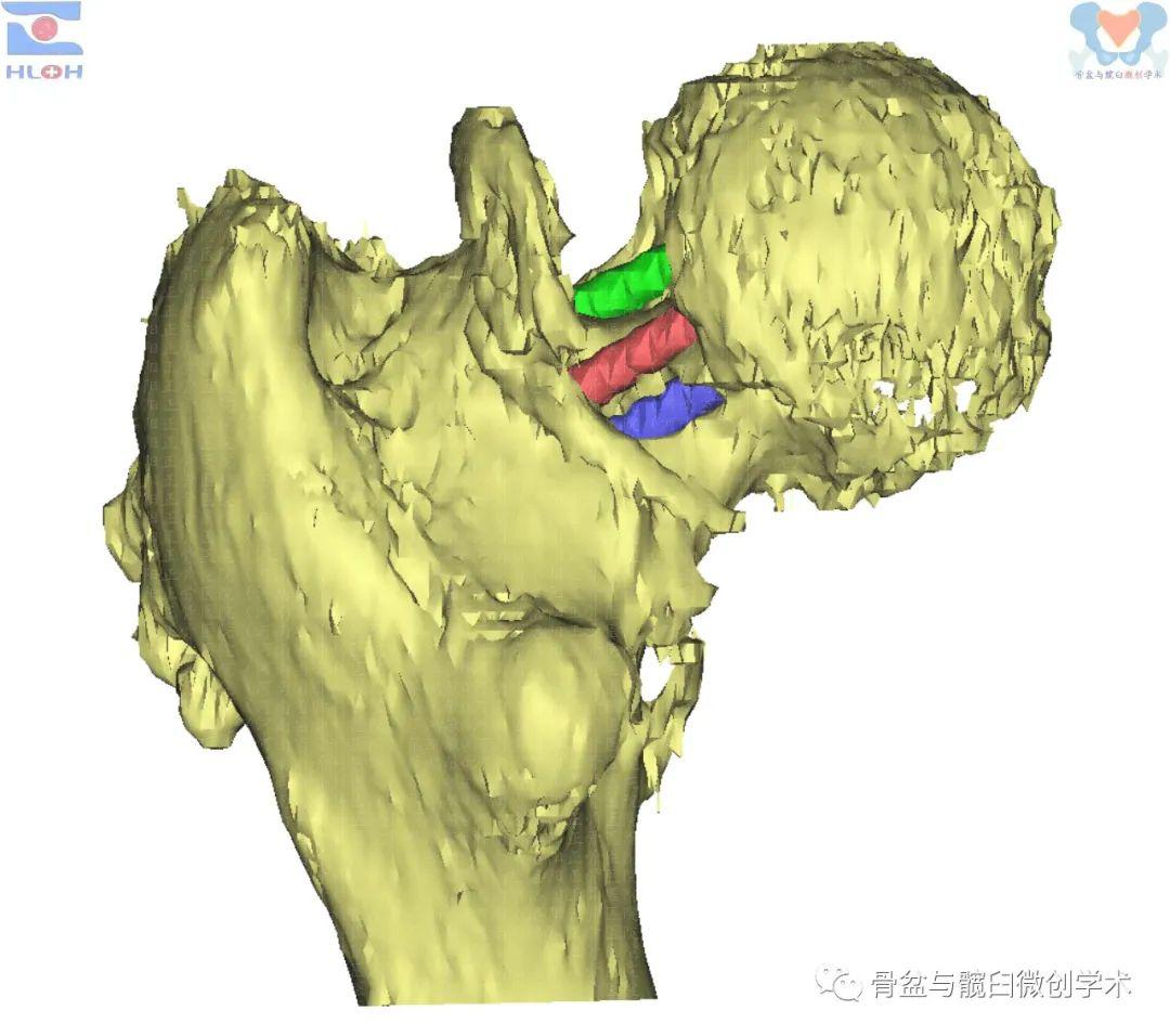 股骨头无坏死股骨颈远折部头端骨质相对过剩颈干角减小,股骨颈短缩