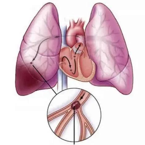 肺动脉人口图片_肺动脉高压图片