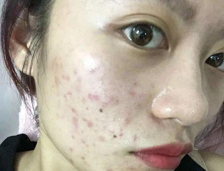 怎么才能不生痘痘 cc9c0322f42b4bbe865fd2477857af47.jpeg