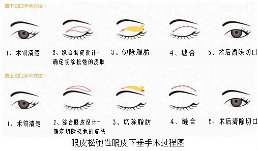 去割双眼皮为啥总让你做上睑提肌