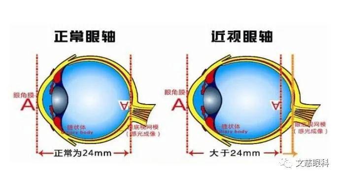 眼镜片的原理_蔡司成长乐眼镜片的原理优缺点 到底好不好(2)