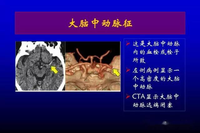 急性脑梗死的影像学表现