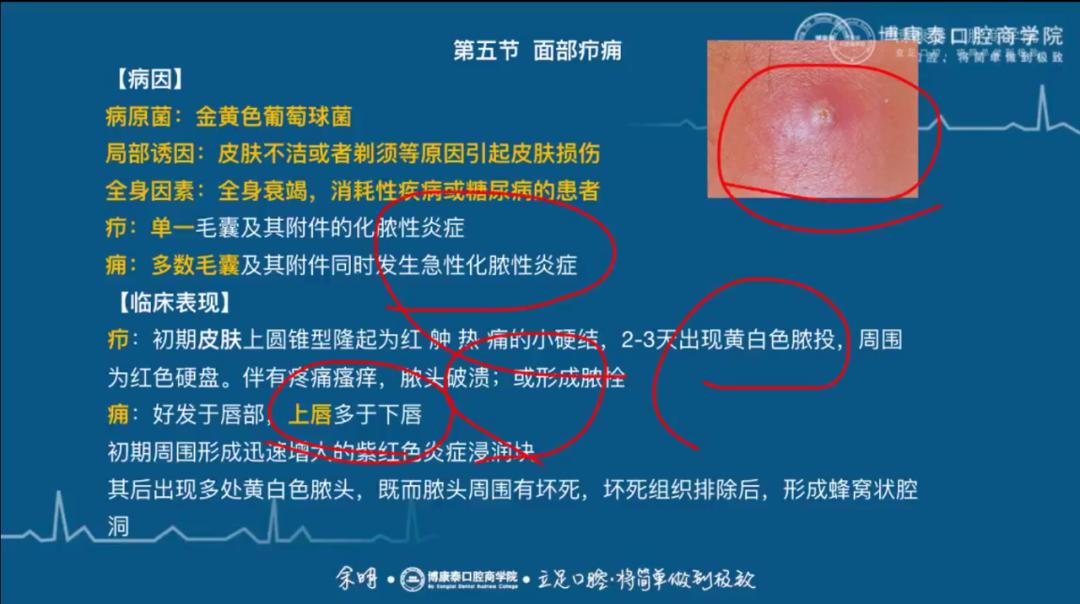 4月24日【医考】口腔颌面外科学—口腔颌面部间隙感染