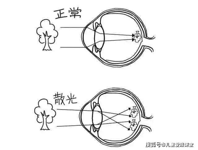 平行光线进入眼内后,由于眼球在不同子午线上屈光力不等, 无法在