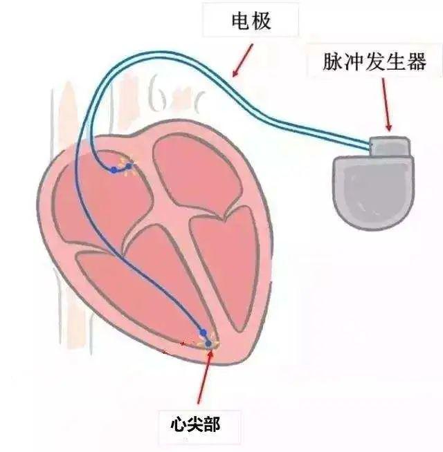 人口普查传导顺序_心脏心电传导顺序动图(3)