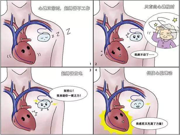 妍论健康安置永久型起搏器患者旅行须知