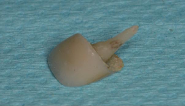 后的基牙状态,缺乏充分牙体组织,唇侧和邻面的牙本质肩领高度小于0