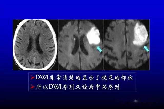 急性脑梗死的影像学表现