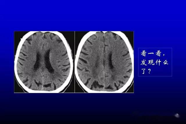 急性脑梗死的影像学表现