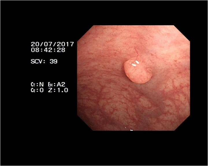 5毫米直肠息肉20年后长成癌 其实可以早"排雷"