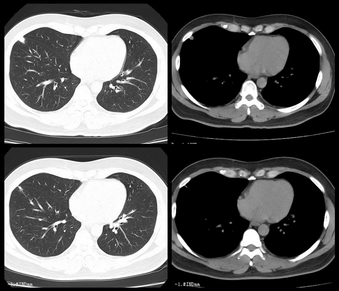 肺部 CT 阅片技巧剖析 障眼法再也不怕了 - 丁香园