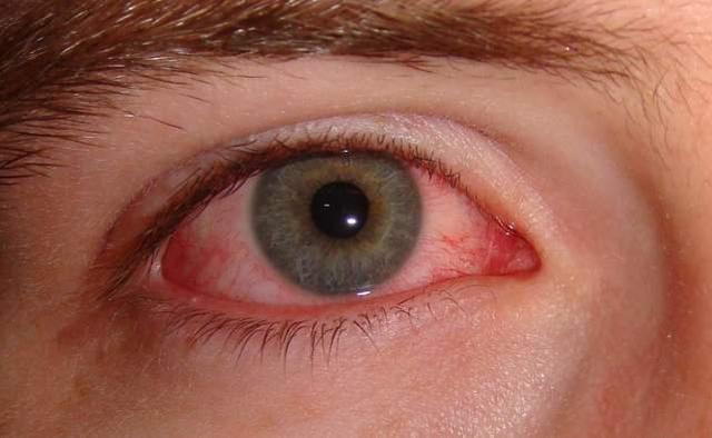 研究發現新冠病毒可在眼記憶體活數周，眼睛發紅或為感染前兆 國際 第1張
