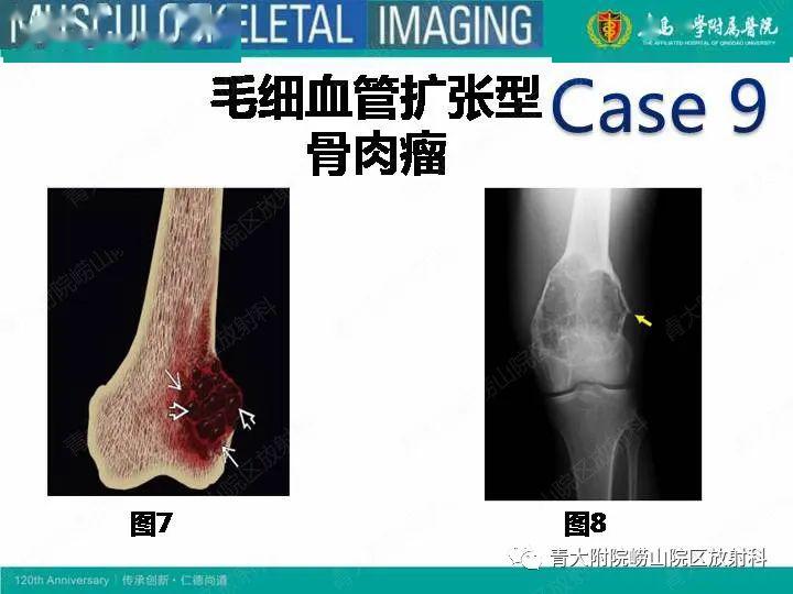 【每日一例1061】男,进行性膝部疼痛—骨肉瘤