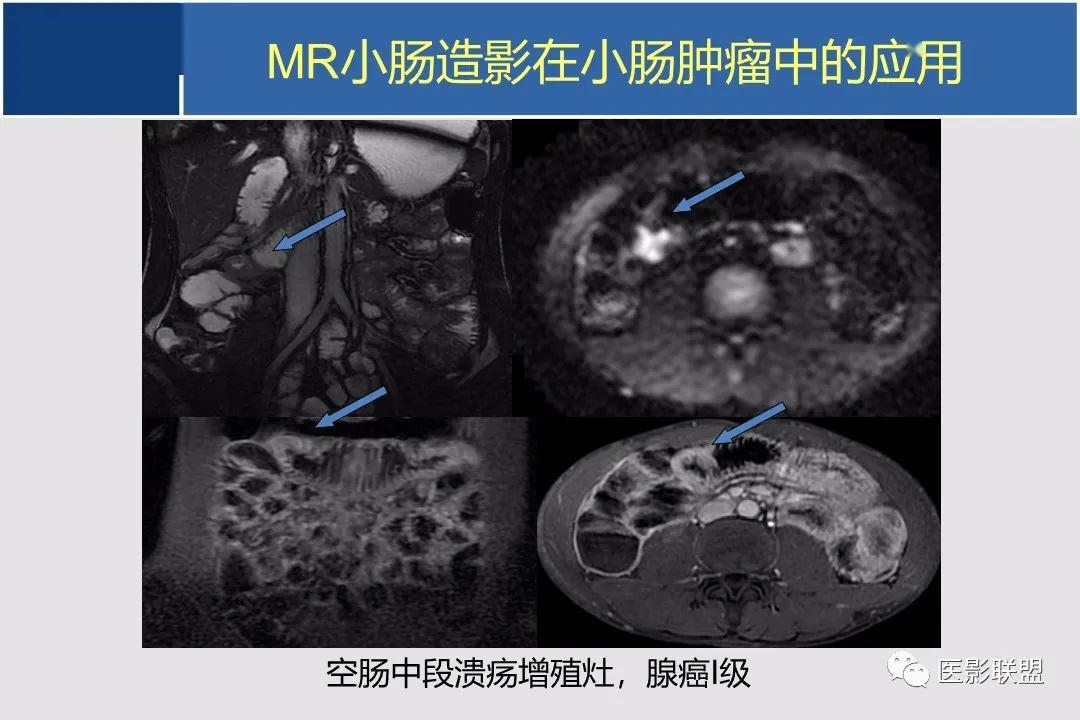 小肠ct,mr影像诊断及进展