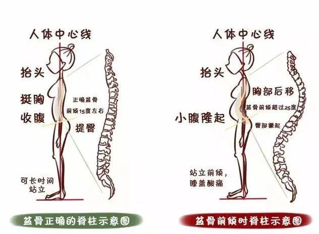 男女都有的骨盆前倾,每天练5分钟,帮你矫正骨盆