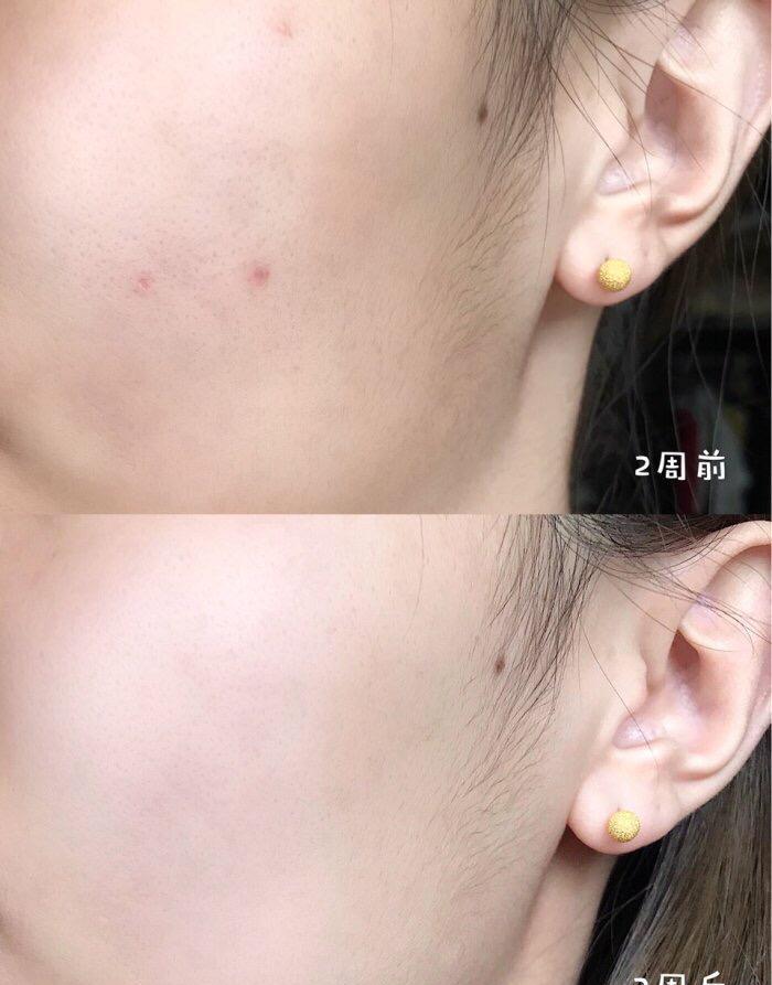 怎么才能不长黑头闭口 1338ab6ef8b544f7b5565d4dbe8cc4fa.jpeg