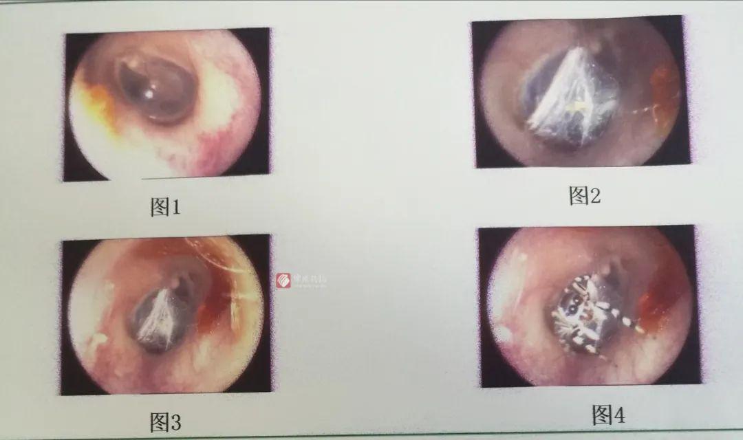 蜘蛛：医生一看惊了！里面居然有…，停电信息|女子突然耳鸣刺痛