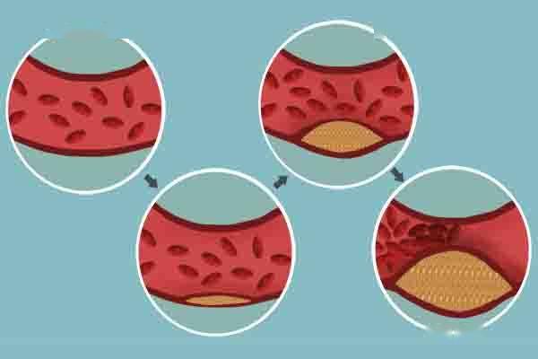 什么叫高胆固醇 1f6872bfc3d1451f905a73ea028aeea5.jpeg