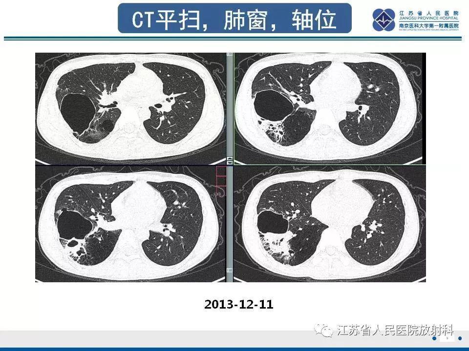 肺先天性囊性腺瘤样畸形