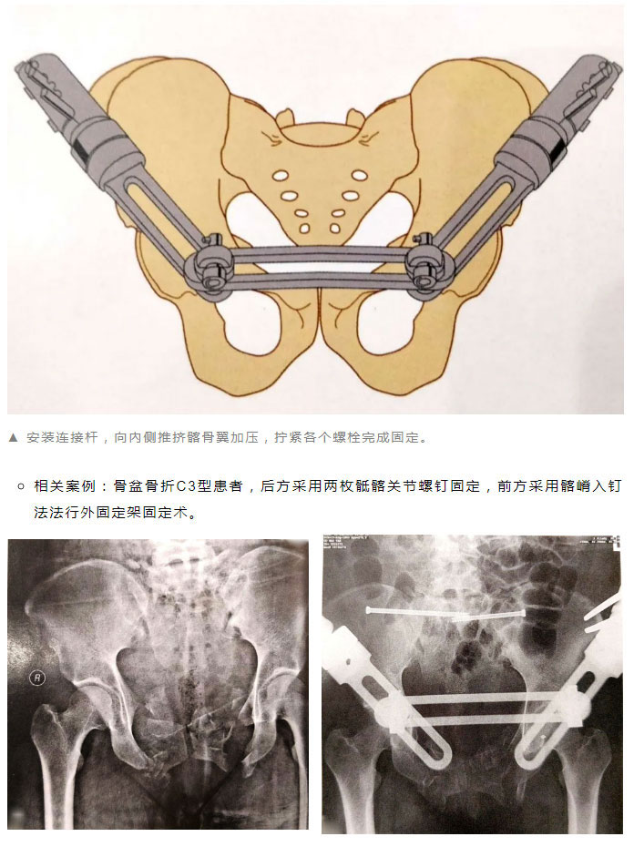 骨学堂骨盆骨折的外固定和急救技术讲解