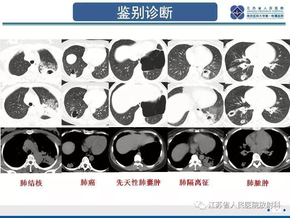 肺先天性囊性腺瘤样畸形