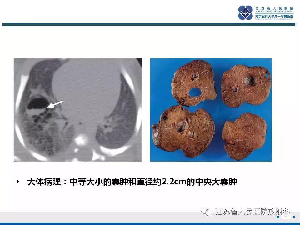 肺先天性囊性腺瘤样畸形