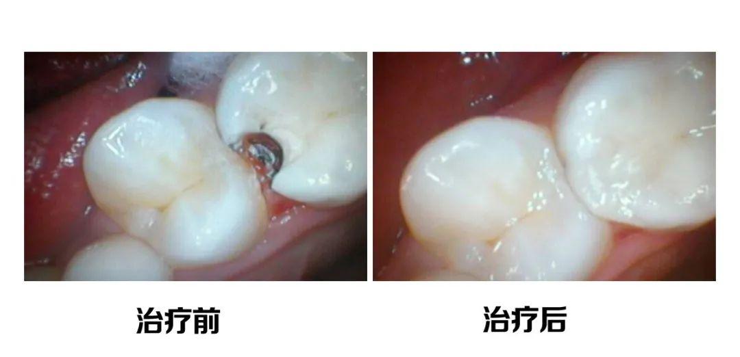 而已经形成龋洞的蛀牙,则需要先去除龋坏组织和失去智齿的薄弱牙体