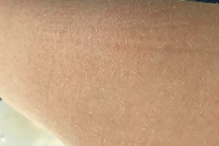露腿露手臂的季节快到了，身上干燥脱屑的部位这样拯救最有效