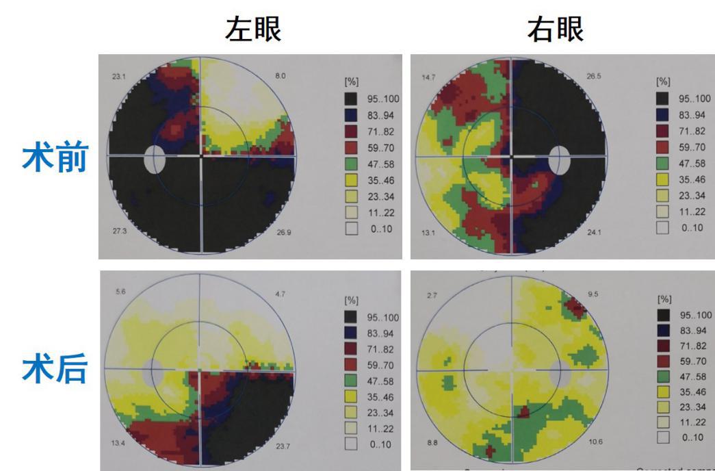 术后双眼视野较术前有了明显改善