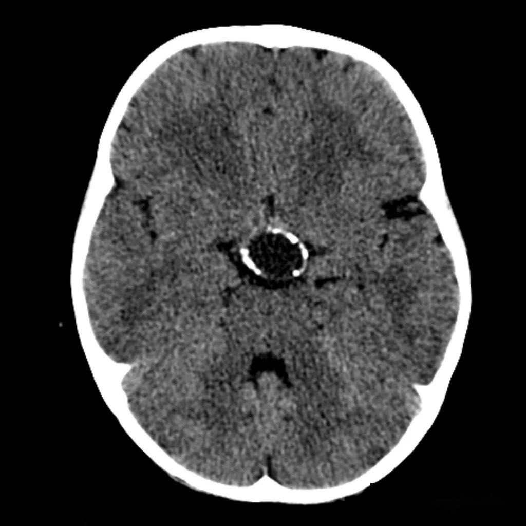 聚沙成塔颅咽管瘤craniopharyngioma