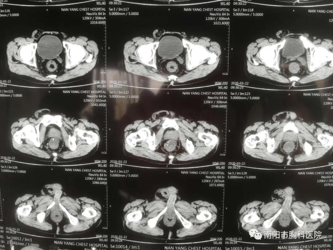 患者男性骨盆狭小,肿瘤巨大,侵犯前列腺,尿道,两侧盆壁受侵,肠系膜