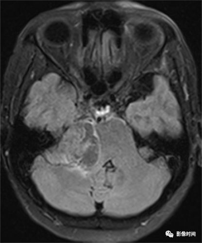 case 2:34 岁,女性,左侧桥小脑角区听神经鞘瘤脑膜瘤颅内脑外最常见的