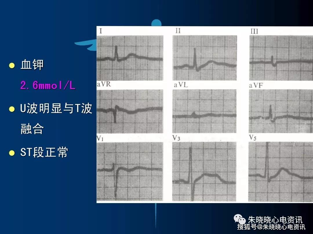 血钾与心电图