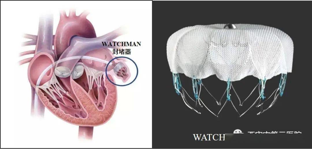 左心耳封堵术与 watchman 封堵器