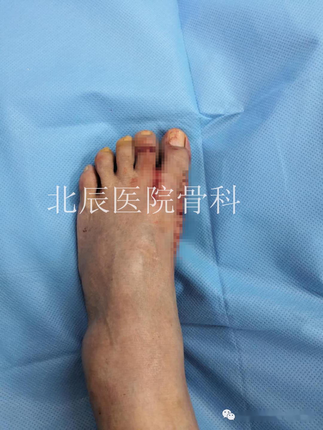 手臂外翻是什么样的 42b924a01a784cd9be13336edb9a46e5.jpeg