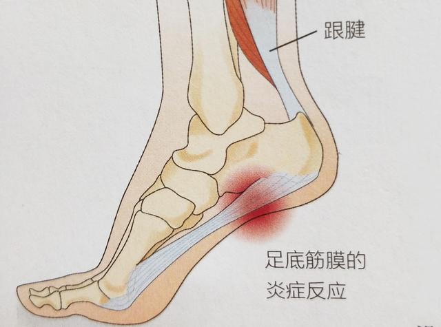 (二)跟腱病: 小腿三头肌由腓肠肌和比目鱼肌组成,两者的肌腱汇合成一