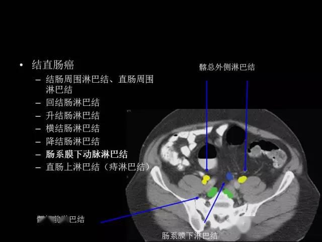 腹部淋巴结影像解剖彩色高清图谱