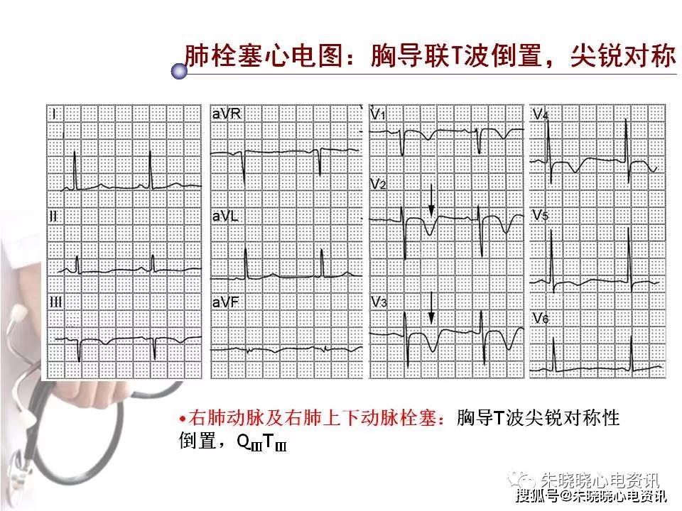 肺栓塞的心电图及临床新认识