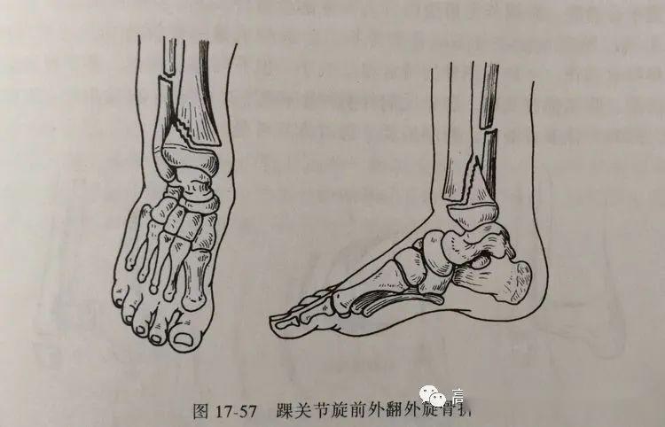 伤后x线片显示:右胫骨远端骨骺分离Ⅱ型,外侧干骺端有三角形骨块
