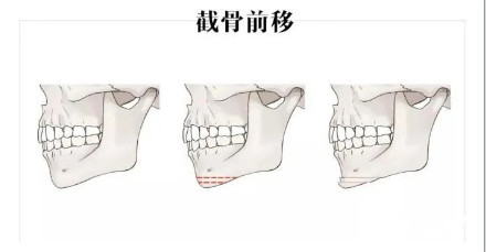 下颚宽大怎么办