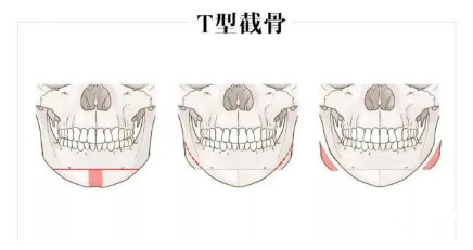 下颚宽大怎么办