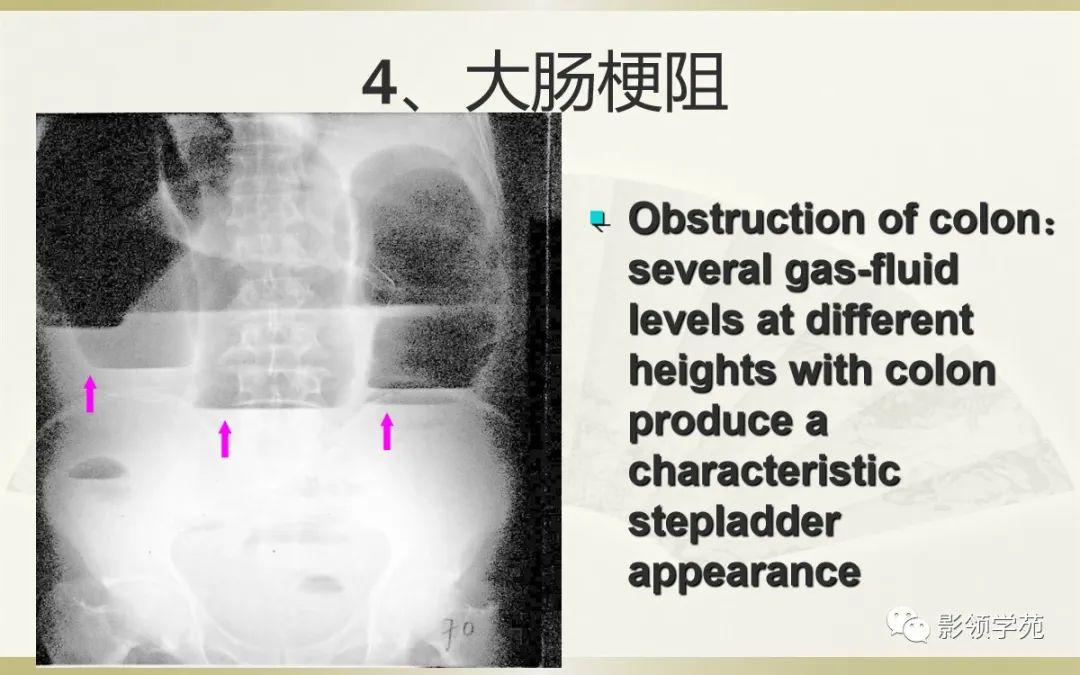 肠梗阻的分类及影像表现