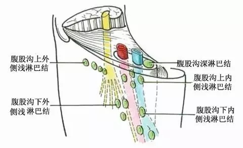 3,妇科疾病,找腹股沟淋巴!