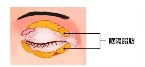 眼袋眶隔释放的利弊有哪些?心痛不已!做完眼袋手术有瘀血咋办?