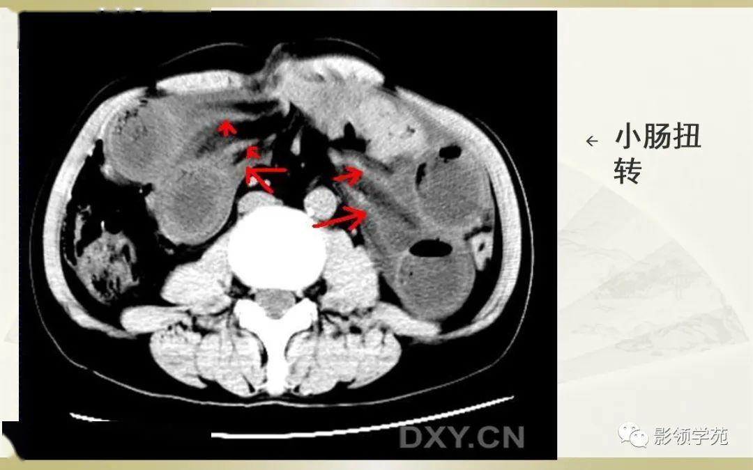肠梗阻的分类及影像表现