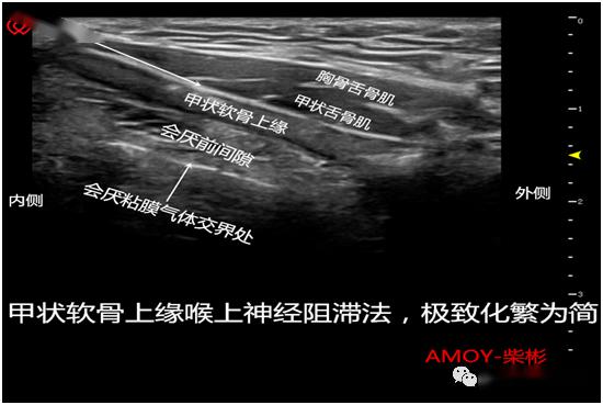 超声专题超声引导喉上神经阻滞的临床实战思维